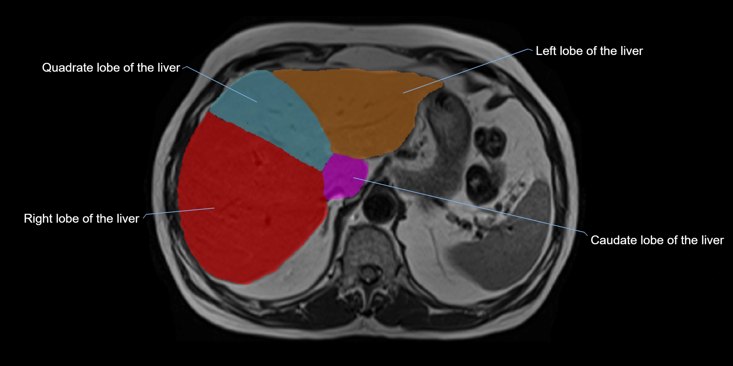 MRI liver lobe axial cross sectional 3T radiology  image-img-00001-00011.webp